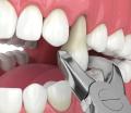 Dental-Extractions