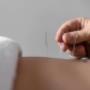 Acupuncture in Dublin.jpg