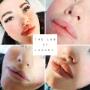 Lip fillers in Dublin
