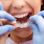 What are Invisible Aligners ?