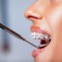 What are Metal Braces?